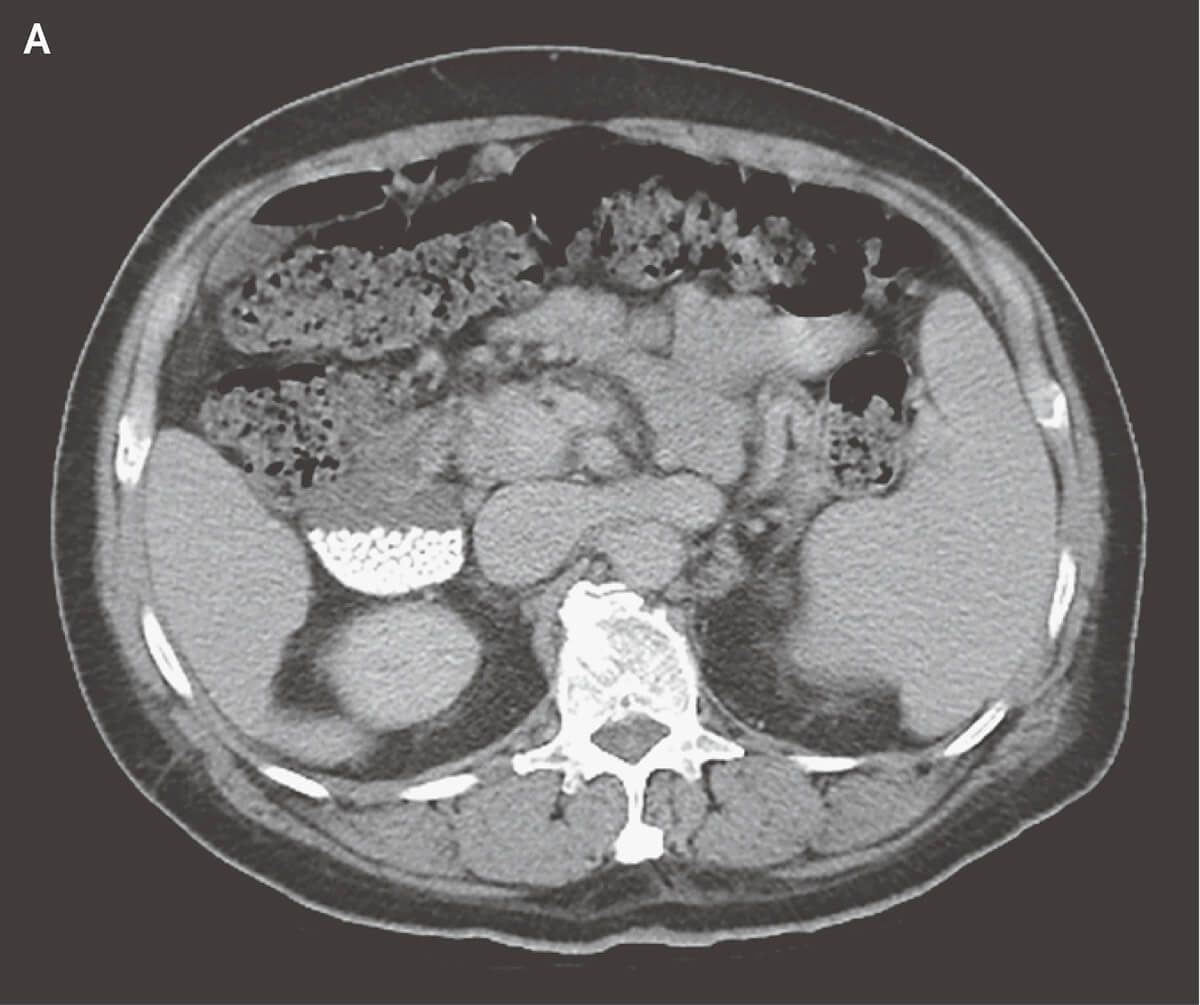 胆石症 NEJM医学前沿