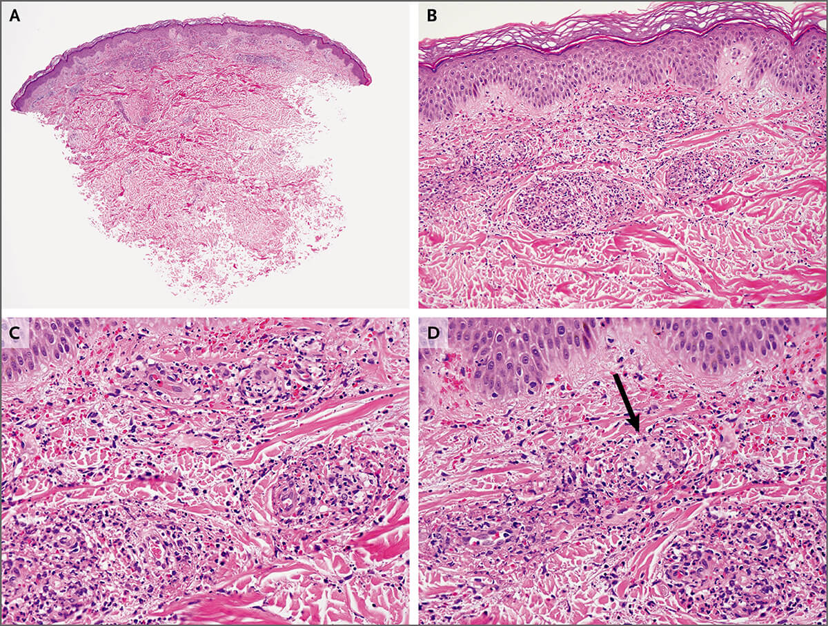 图3. &nbsp;左侧 足踝 的皮肤活检标本( 苏木精   伊红染色)