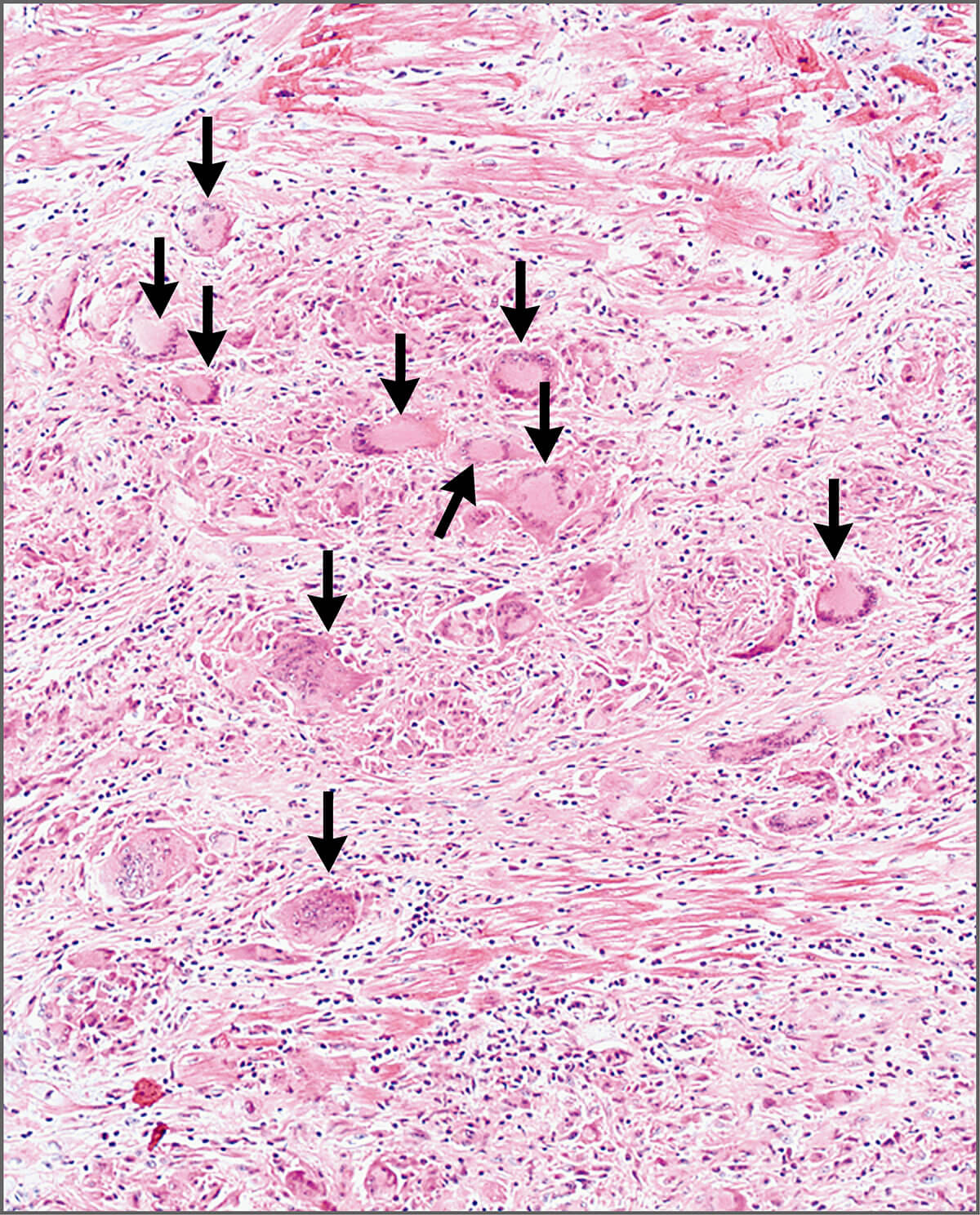图4.  心内膜心肌活检标本的显微照片