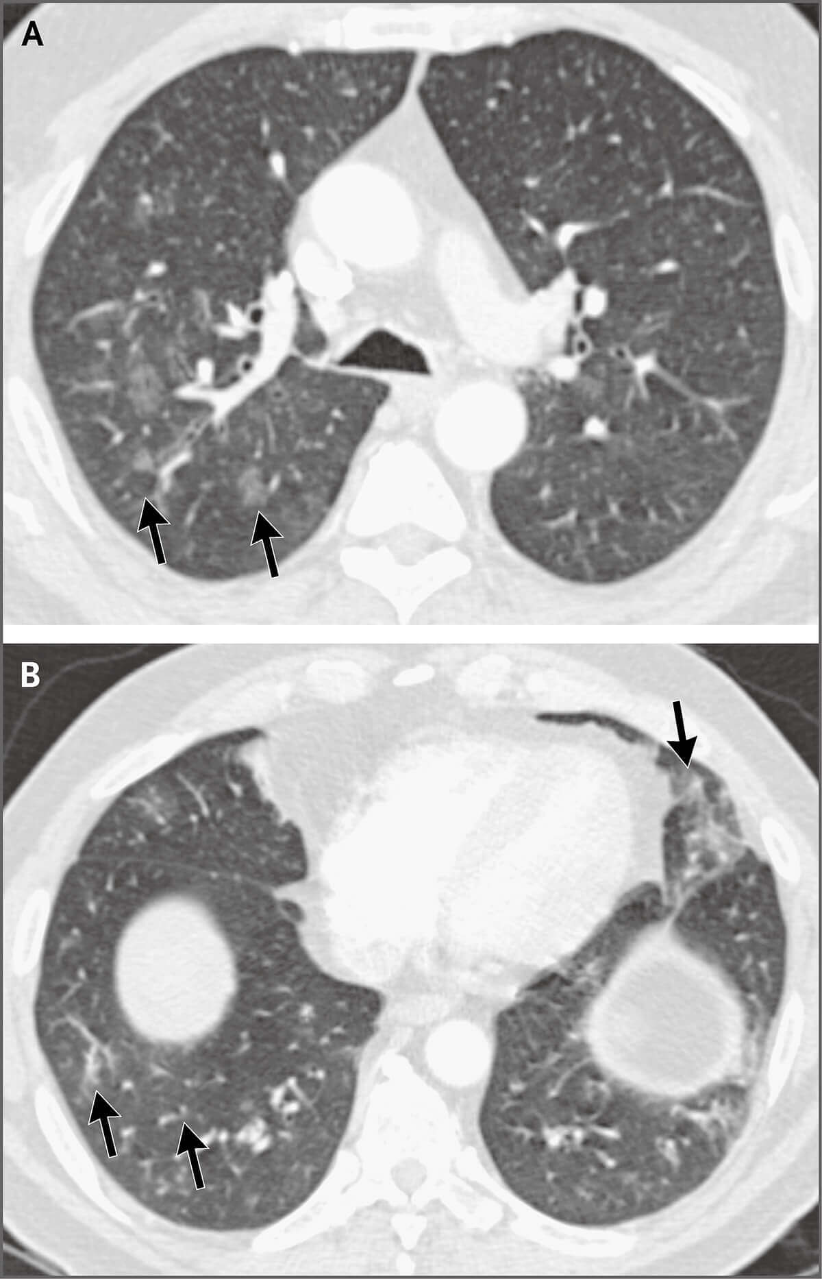 图1.胸部增强ct扫描