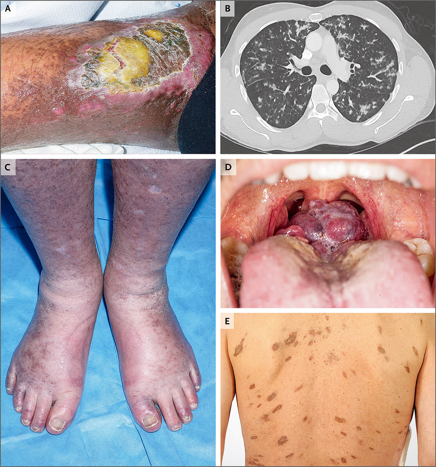 肉瘤癌早期症状图片