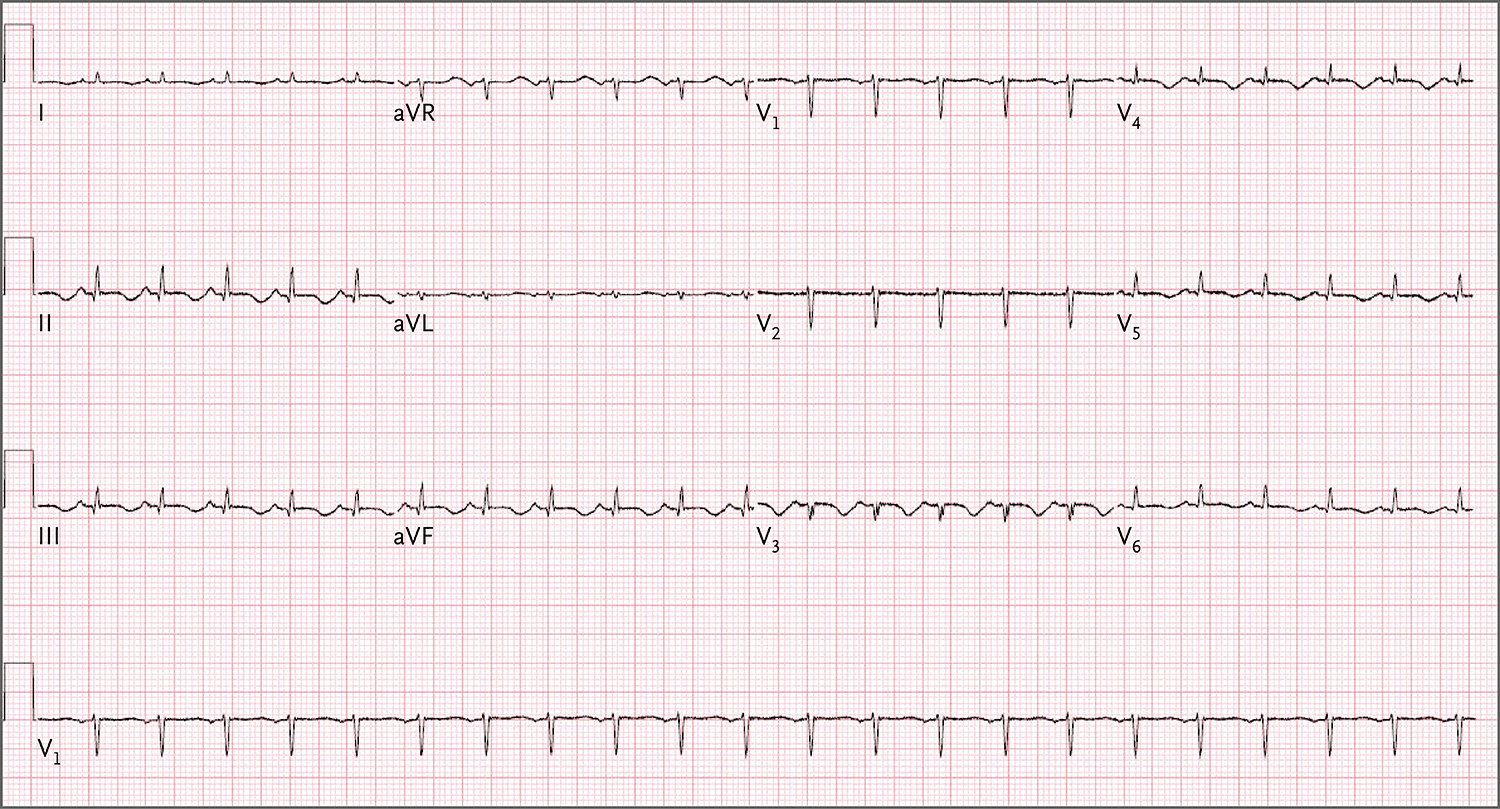 r波进展不良,v3至v6导联以及下壁导联t波倒置,qrs低电压,按心率校正的