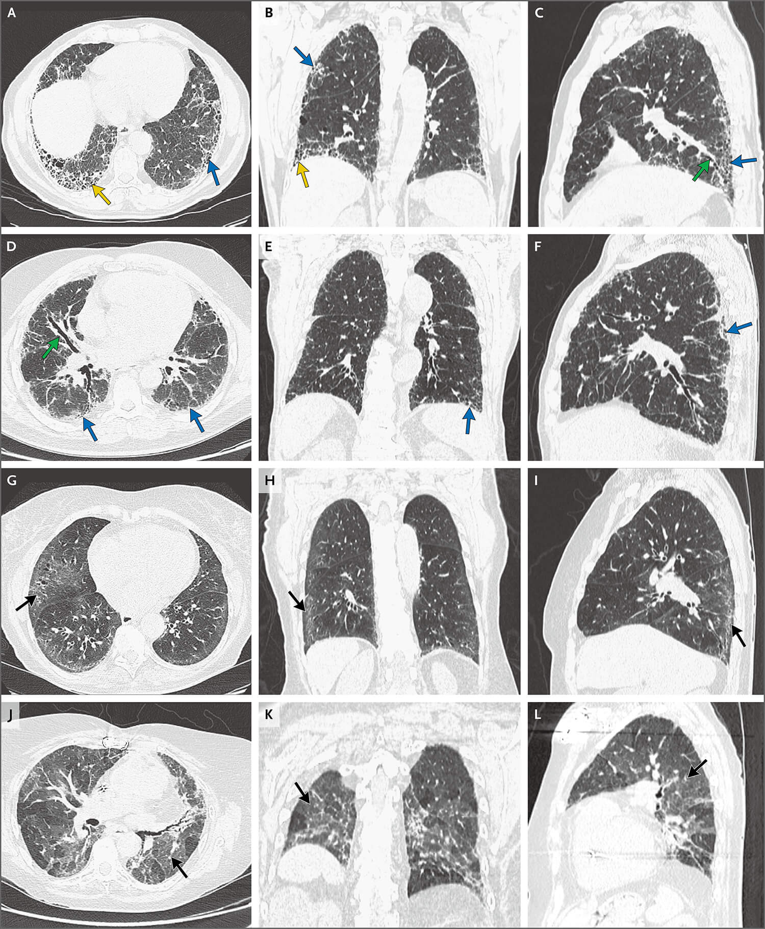 _左下肺肺纤维化影像图片_有来医生