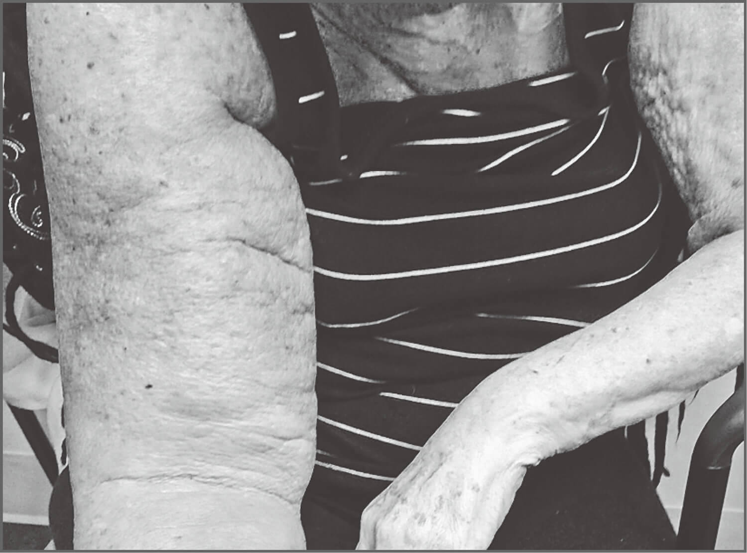 乳腺癌术后手臂水肿图-图库-五毛网