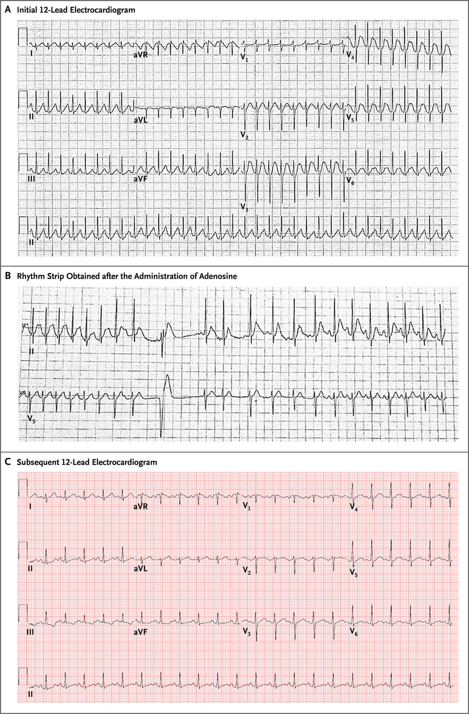 病例24-2019 ——一名患心悸,腹痛和呕吐的39岁女性