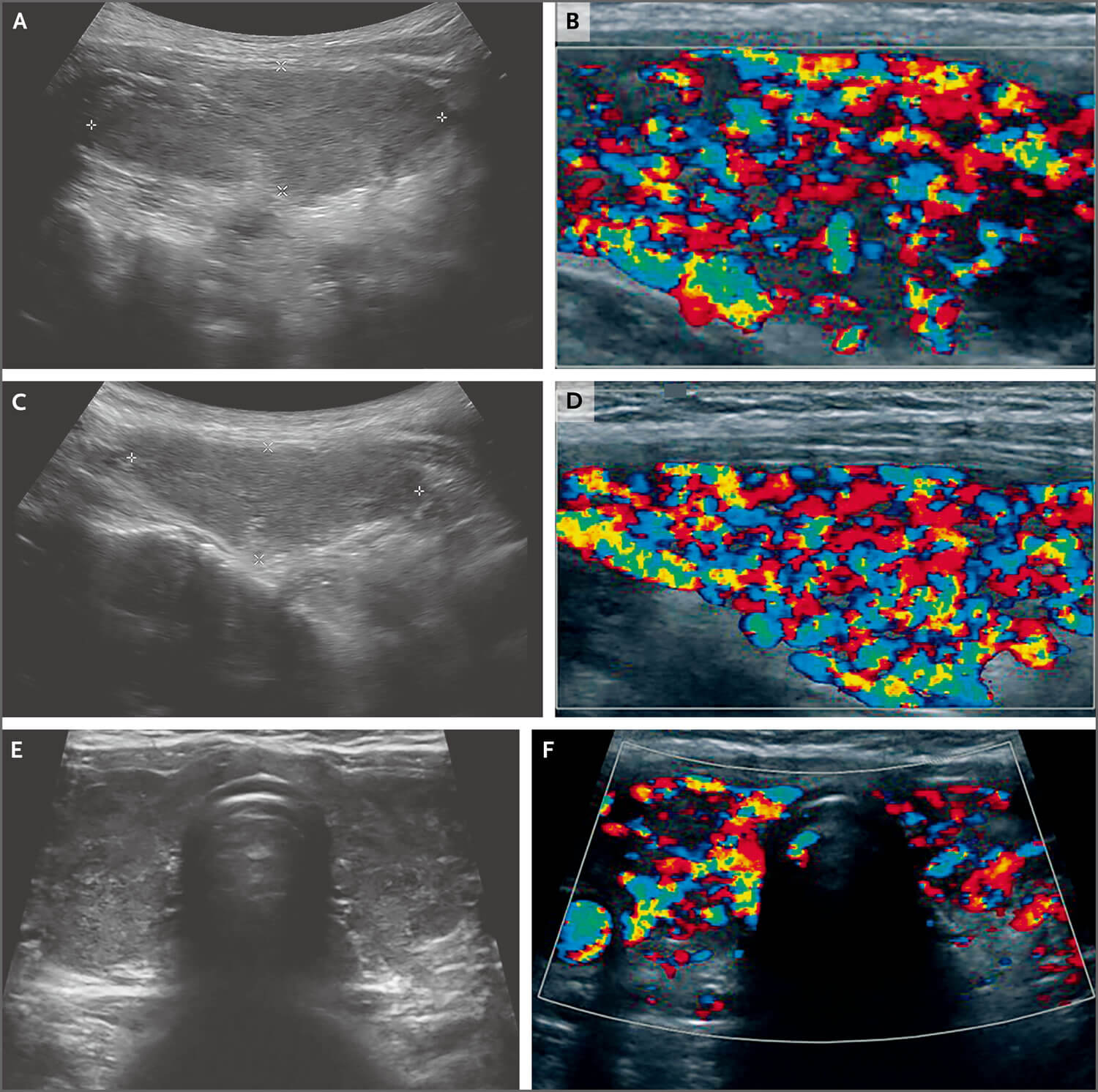 病例24-2019 ——一名患心悸,腹痛和呕吐的39岁女性