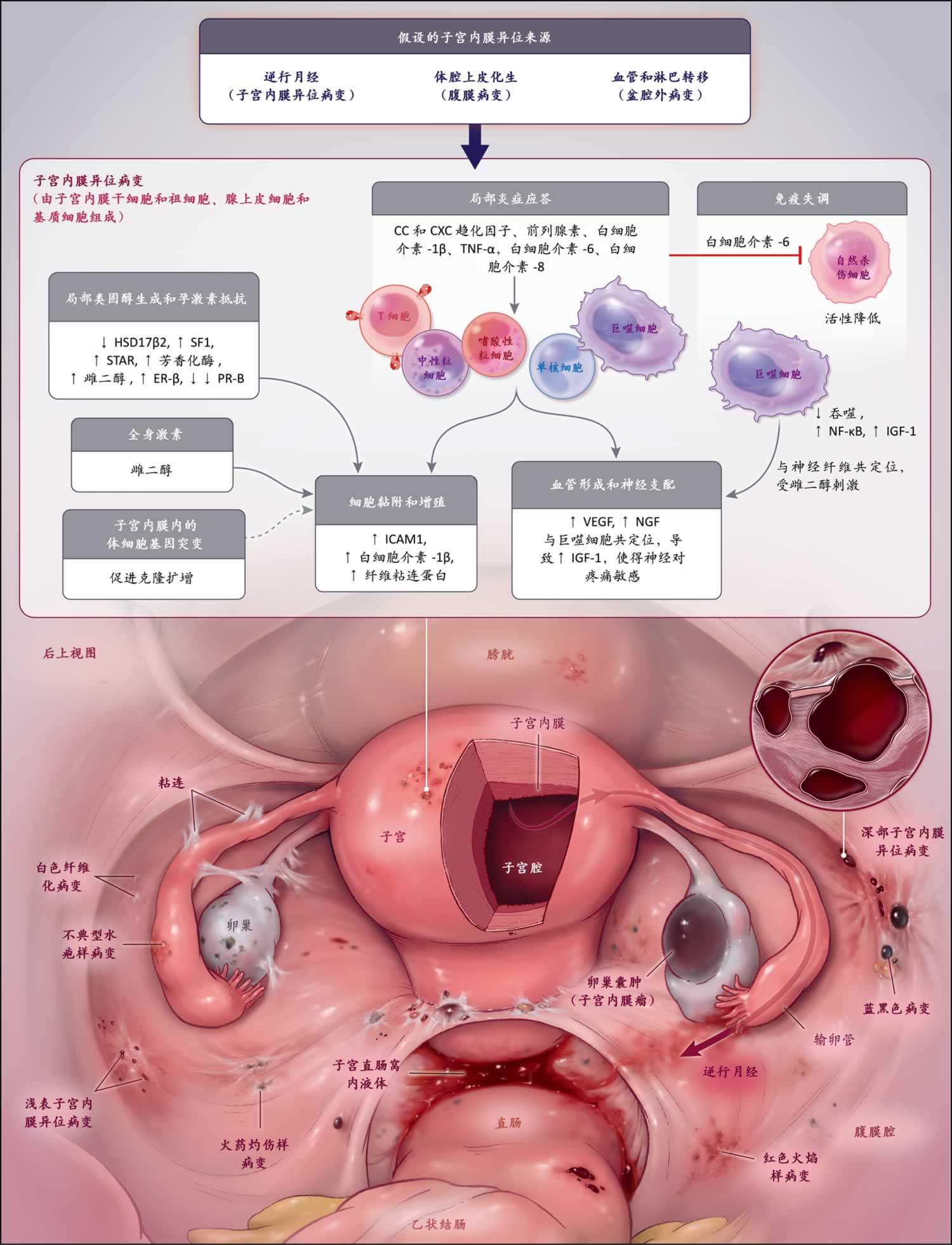 子宫内膜异位症 Nejm医学前沿