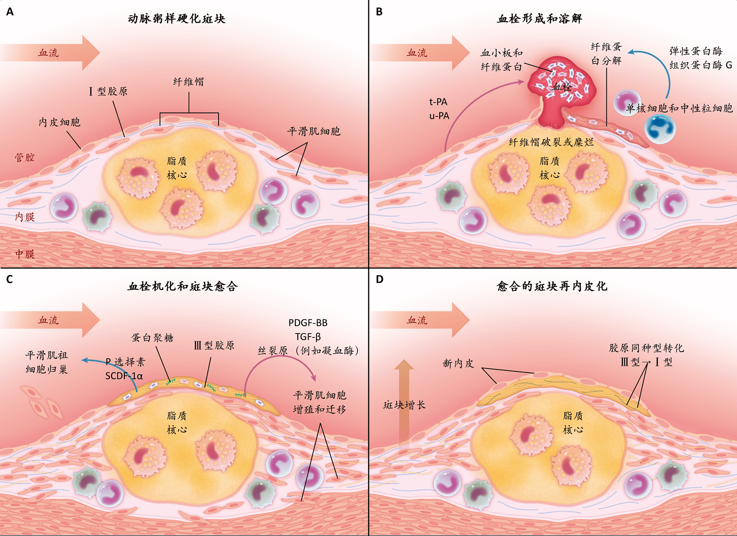 动脉粥样硬化斑块的愈合 Nejm医学前沿 动脉粥样硬化斑块的愈合 Nejm医学前沿