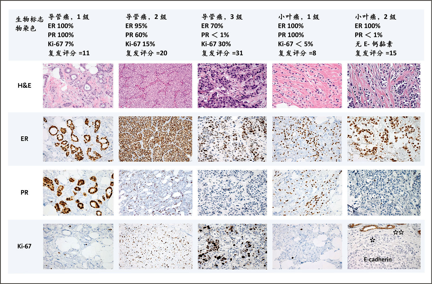 雌激素受体阳性 Her2阴性乳腺癌的全身性治疗 Nejm医学前沿 雌激素受体阳性 Her2阴性乳腺癌的全身性治疗 Nejm医学前沿